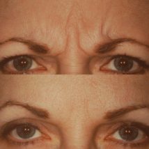 botox before and after above eyes and eyebrows