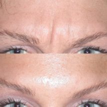botox before and after eyebrows