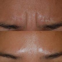 botox before and after forehead and eyebrows