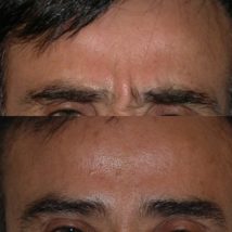 Botox before and after eyebrows