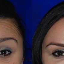 Gilman Kara botox before and after photo