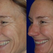 Botox before and after crows feet