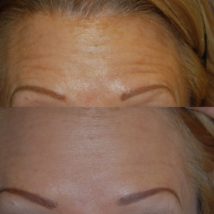Botox before and after woman's forehead